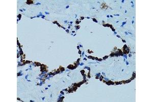 Immunohistochemistry of paraffin-embedded Human lung using CTSE Polyclonal Antibody at dilution of 1:100 (40x lens). (Cathepsin E anticorps)