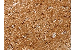 The image on the left is immunohistochemistry of paraffin-embedded Human brain tissue using ABIN7192664(SSX4 Antibody) at dilution 1/20, on the right is treated with synthetic peptide. (SSX4 anticorps)