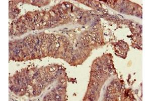 Immunohistochemistry of paraffin-embedded human endometrial cancer using ABIN7173463 at dilution of 1:100 (TRIM54 anticorps  (AA 60-358))