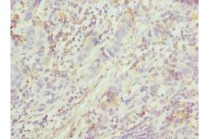 Immunohistochemistry of paraffin-embedded human bladder cancer using ABIN7153264 at dilution of 1:100 (FGD5 anticorps  (AA 1203-1462))