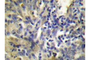 Immunohistochemistry analyzes of Cystatin A antibody in paraffin-embedded human lung carcinoma tissue. (CSTA anticorps)
