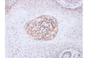 IHC-P Image Immunohistochemical analysis of paraffin-embedded Cal27 xenograft, using c-Met, antibody at 1:100 dilution.