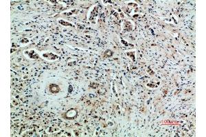 Immunohistochemical analysis of paraffin-embedded human-breast-cancer, antibody was diluted at 1:200.