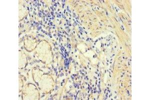 Immunohistochemistry of paraffin-embedded human gastric cancer using ABIN7148597 at dilution of 1:100 (CORO1B anticorps  (AA 252-453))