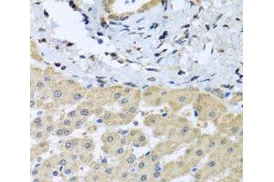 Immunohistochemistry of paraffin-embedded Human liver damage using LETMD1 Polyclonal Antibody at dilution of 1:100 (40x lens).
