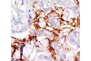 IHC analysis of FFPE human breast carcinoma tissue stained with the PAK3 antibody