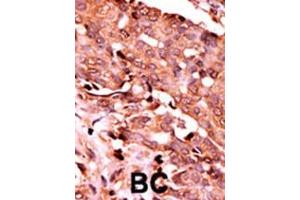 Formalin-fixed and paraffin-embedded human cancer tissue reacted with the primary antibody, which was peroxidase-conjugated to the secondary antibody, followed by AEC staining.