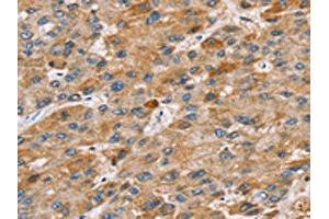 The image on the left is immunohistochemistry of paraffin-embedded Human liver cancer tissue using ABIN7131211(STARD8 Antibody) at dilution 1/30, on the right is treated with fusion protein. (STARD8 anticorps)