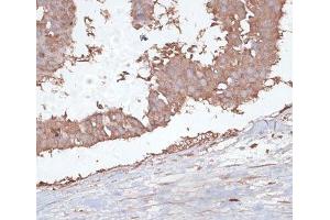Immunohistochemistry of paraffin-embedded Human mammary cancer using TGFBR2 Polyclonal Antibody at dilution of 1:100 (40x lens). (TGFBR2 anticorps)
