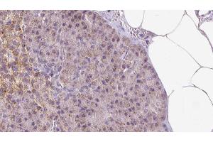 ABIN6273293 at 1/100 staining Human pancreas cancer tissue by IHC-P. (PDIA6 anticorps  (C-Term))
