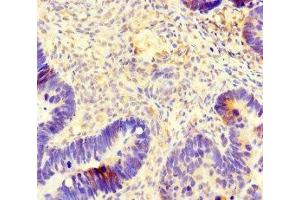 Immunohistochemistry of paraffin-embedded human ovarian cancer using ABIN7173691 at dilution of 1:100