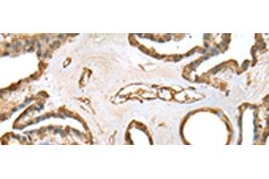 Immunohistochemistry of paraffin-embedded Human thyroid cancer tissue using SFN Polyclonal Antibody at dilution of 1:25(x200)