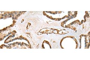 Immunohistochemistry of paraffin-embedded Human thyroid cancer tissue using SFN Polyclonal Antibody at dilution of 1:25(x200) (14-3-3 sigma/SFN anticorps)
