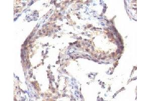IHC testing of FFPE human testicular carcinoma with TGF alpha antibody (TGFA anticorps  (C-Term))