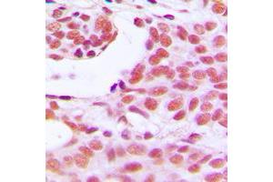 Immunohistochemical analysis of HOXD12 staining in human breast cancer formalin fixed paraffin embedded tissue section.