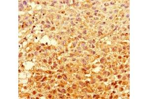 Immunohistochemistry of paraffin-embedded human melanoma using ABIN7154056 at dilution of 1:100 (GCDH anticorps  (AA 45-300))