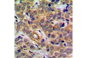 Immunohistochemical analysis of NF-kappaB p65 (pS311) staining in human breast cancer formalin fixed paraffin embedded tissue section.