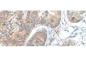 Immunohistochemistry of paraffin-embedded Human gastric cancer tissue using BCAN Polyclonal Antibody at dilution of 1:35(x200) (BCAN anticorps)