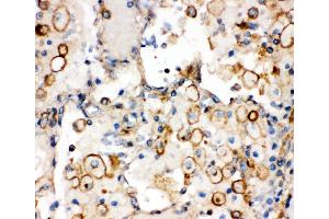 Anti-Integrin alpha 1 antibody,  IHC(P) IHC(P): Human Lung Cancer Tissue (Integrin alpha 1 anticorps  (C-Term))