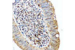 Immunohistochemistry of paraffin-embedded human lung cancer using /IB Rabbit pAb (2391) at dilution of 1:50 (40x lens). (Iba1 anticorps  (AA 1-147))