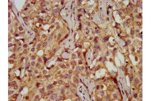IHC image of ABIN7149571 diluted at 1:200 and staining in paraffin-embedded human liver cancer performed on a Leica BondTM system.