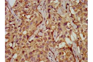 IHC image of ABIN7149571 diluted at 1:200 and staining in paraffin-embedded human liver cancer performed on a Leica BondTM system. (PDSS2 anticorps  (AA 292-387))