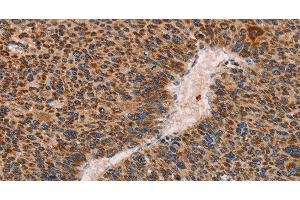 Immunohistochemistry of paraffin-embedded Human liver cancer using MMP1 Polyclonal Antibody at dilution of 1:60 (MMP1 anticorps)
