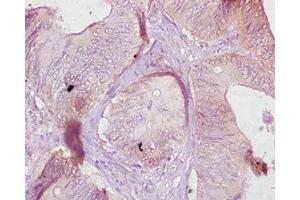 Immunohistochemistry of paraffin-embedded human colon cancer using ABIN7177073 at dilution of 1:10 (CES1C anticorps  (AA 19-550))
