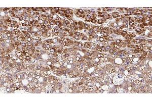 ABIN6279842 at 1/100 staining Human liver cancer tissue by IHC-P. (SLC10A4 anticorps  (C-Term))
