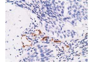 Immunohistochemical staining of paraffin-embedded Carcinoma of Human bladder tissue using anti-AFP mouse monoclonal antibody. (alpha Fetoprotein anticorps)
