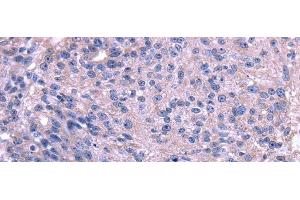 Immunohistochemistry of paraffin-embedded Human breast cancer using TRIM14 Polyclonal Antibody at dilution of 1/35 (TRIM14 anticorps)