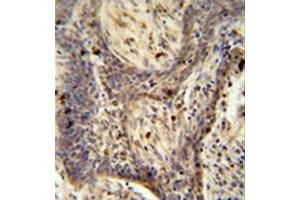 Formalin fixed and paraffin embedded human lung carcinoma reacted with PPRC1 Antibody (C-term) followed by peroxidase conjugation of the secondary antibody and DAB staining. (PPRC1 anticorps  (C-Term))