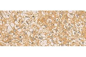 Immunohistochemistry of paraffin-embedded Human liver cancer tissue using FAAP100 Polyclonal Antibody at dilution of 1:50(x200) (C17orf70 anticorps)