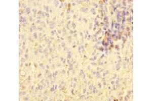 Immunohistochemistry of paraffin-embedded human melanoma using ABIN7170802 at dilution of 1:100