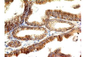 Formalin-fixed, paraffin-embedded human Colon Carcinoma stained with E-Cadherin Monoclonal Antibody (CDH1/1525).