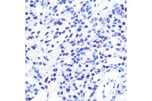 Immunohistochemistry of paraffin-embedded Human oophoroma using CHD4 antibody (ABIN6127308, ABIN6138512, ABIN6138513 and ABIN6215263) at dilution of 1:100 (40x lens). (CHD4 anticorps  (AA 1520-1690))