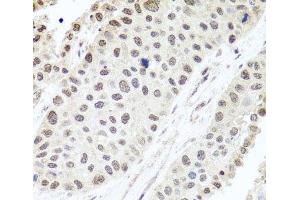 Immunohistochemistry of paraffin-embedded Human lung cancer using ALKBH4 Polyclonal Antibody at dilution of 1:100 (40x lens). (ALKBH4 anticorps)
