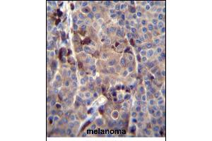 PREF8 Antibody (C-term) (ABIN656145 and ABIN2845481) immunohistochemistry analysis in formalin fixed and paraffin embedded human melanoma tissue followed by peroxidase conjugation of the secondary antibody and DAB staining. (PRAMEF8 anticorps  (C-Term))