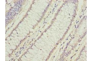 Immunohistochemistry of paraffin-embedded human colon cancer using ABIN7165562 at dilution of 1:100 (FAM78A anticorps  (AA 21-283))