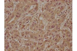 IHC image of ABIN7170322 diluted at 1:100 and staining in paraffin-embedded human liver cancer performed on a Leica BondTM system.