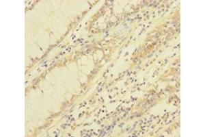 Immunohistochemistry of paraffin-embedded human colon cancer using ABIN7172031 at dilution of 1:100 (TXNL1 anticorps  (AA 2-289))