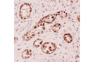Anti-APE1 Picoband antibody,  IHC(P): Human Lung Cancer Tissue (APEX1 anticorps  (AA 2-318))