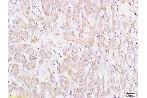 Formalin-fixed and paraffin embedded human hepatocellular carcinoma labeled with Anti WDR16 Polyclonal Antibody, Unconjugated (ABIN720865) at 1:200 followed by conjugation to the secondary antibody and DAB staining (WDR16 anticorps  (AA 401-500))