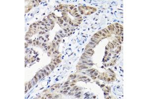 Immunohistochemistry of paraffin-embedded human colon carcinoma using SNRPF Rabbit pAb (ABIN6132678, ABIN6148228, ABIN6148229 and ABIN6215753) at dilution of 1:200 (40x lens). (SNRPF anticorps  (AA 1-86))