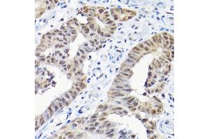 Immunohistochemistry of paraffin-embedded human colon carcinoma using SNRPF Rabbit pAb (ABIN6132678, ABIN6148228, ABIN6148229 and ABIN6215753) at dilution of 1:200 (40x lens). (SNRPF anticorps  (AA 1-86))
