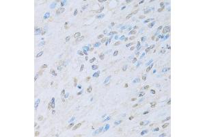 Immunohistochemistry of paraffin-embedded human liver cancer using KAT2A antibody. (KAT2A anticorps)