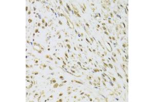 Immunohistochemistry of paraffin-embedded human leiomyoma of uterus using DDX1 Antibody (ABIN5973950) at dilution of 1/100 (40x lens). (DDX1 anticorps)