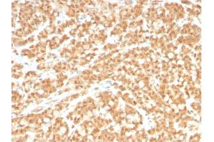 Formalin-fixed, paraffin-embedded human Colon Carcinoma stained with ICOSL-Monospecific Mouse Monoclonal Antibody (ICOSL/3260). (ICOSLG anticorps  (AA 23-149))