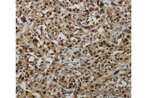 Immunohistochemistry of Human breast cancer using LIG1 Polyclonal Antibody at dilution of 1:70 (LIG1 anticorps)
