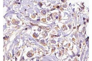 ABIN6276874 at 1/100 staining Human breast cancer tissue by IHC-P. (HMBS anticorps  (Internal Region))